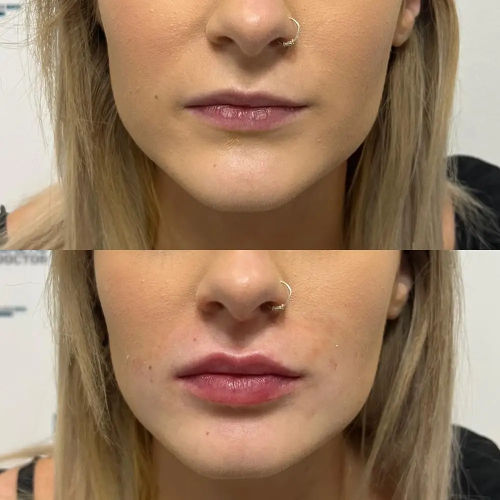 Lip Flip Before and After