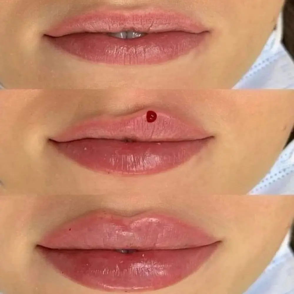 Lip Flip Before and After