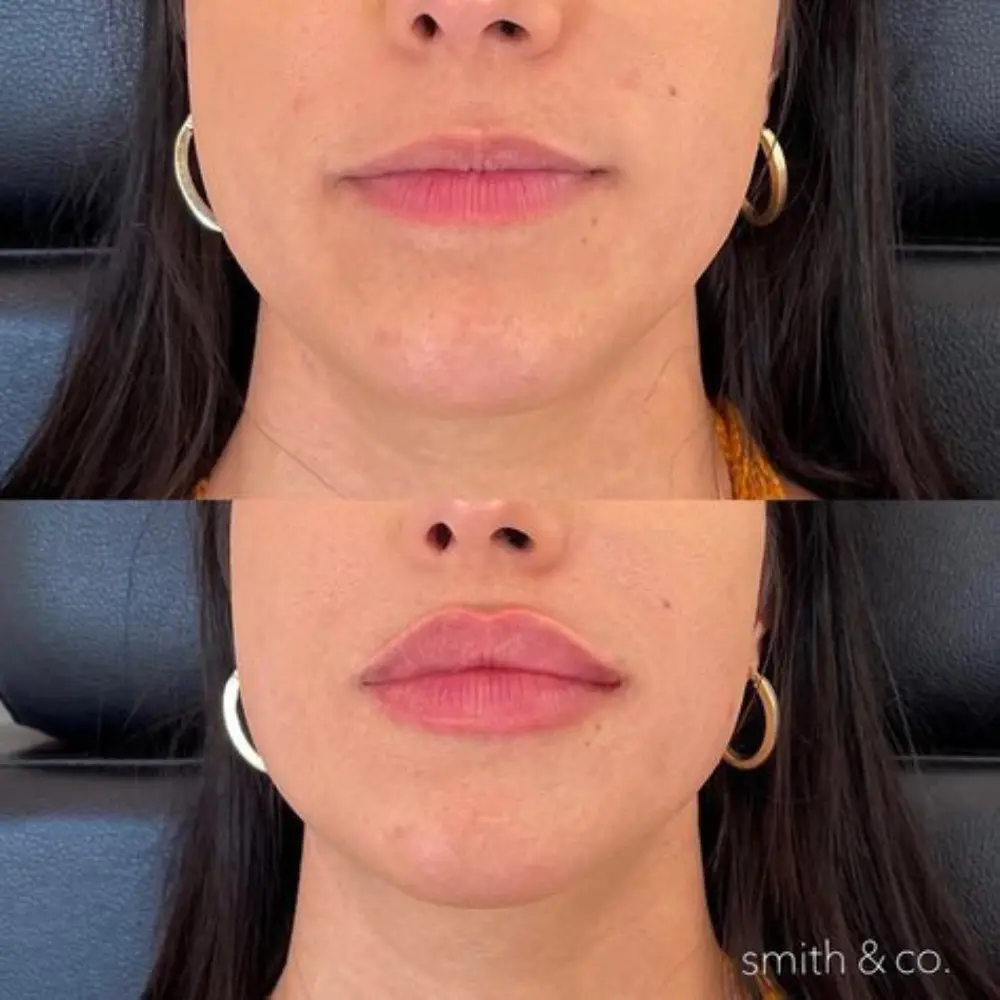 Lip Flip Before and After