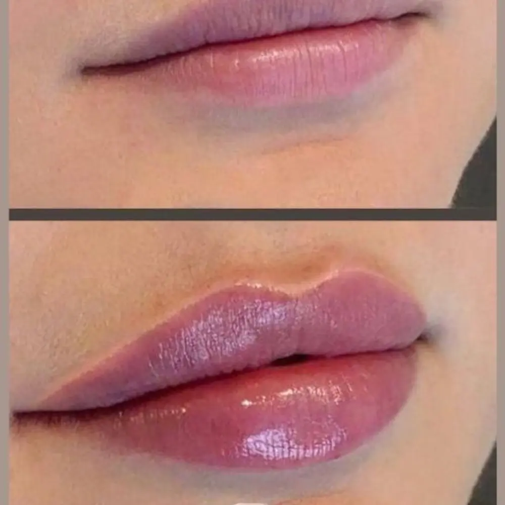 Lip Flip Before and After