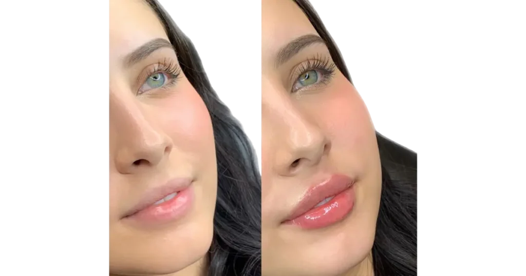 Lip Flip Before and After