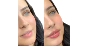 Lip Flip Before and After
