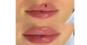 Lip Flip vs Filler