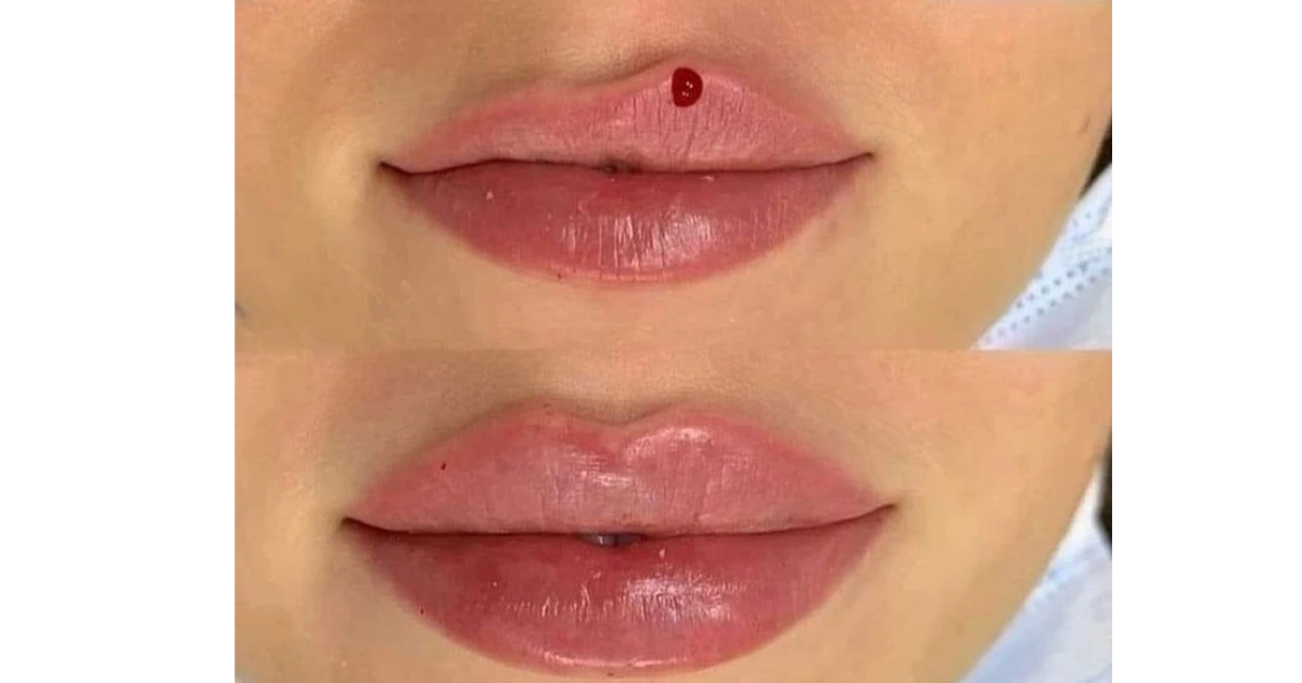 Lip Flip vs Filler