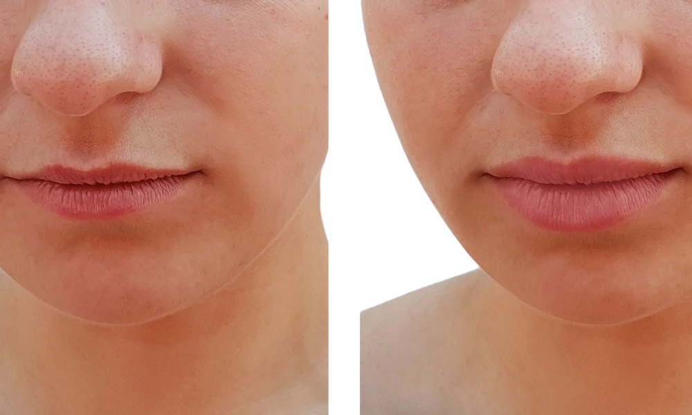 lip flip before and after