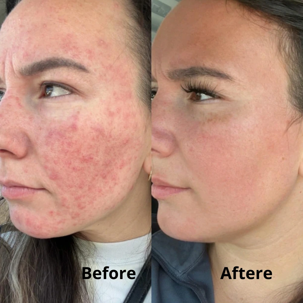PanOxyl vs CeraVe